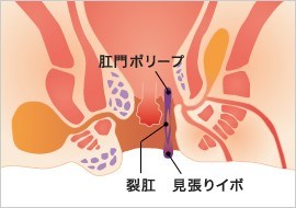 痔とは違う！？肛門ポリープについて